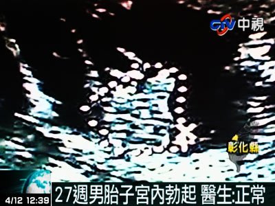 台湾一孕妇产检发现奇景 27周男胎子宫内自慰(图)
