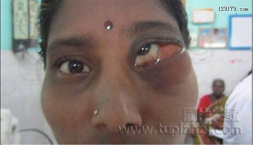 印度女子眼睛里长出两颗牙齿 致左眼出现异常