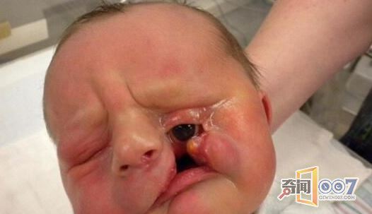 男婴刚出生时面部严重缺陷，没法见人