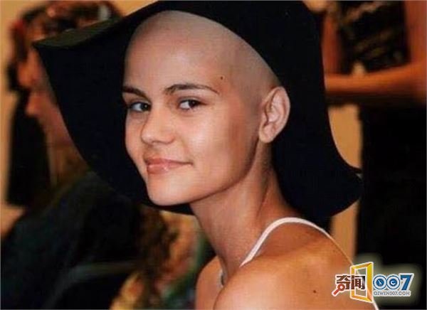 15岁少女患罕见癌症：为模特梦坚持