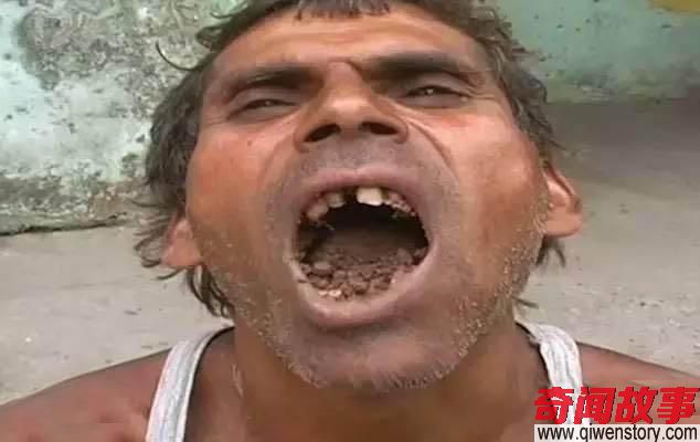 印度男子患异食癖，吃泥土17年，一天要吃掉一斤泥土
