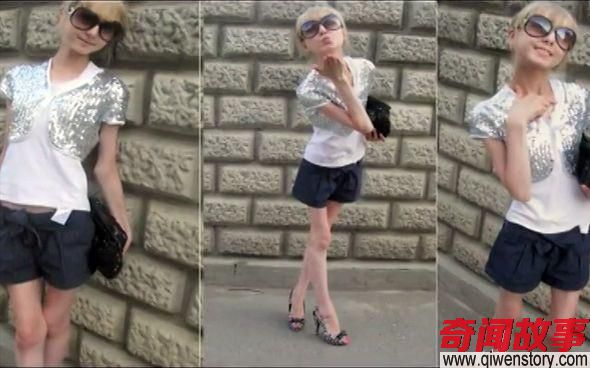 直击24岁俄罗斯女孩减肥变成“活骷髅”，体重只剩42斤