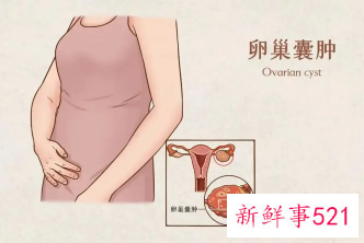 女性卵巢囊肿原因