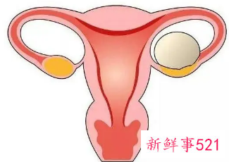 女性卵巢囊肿原因