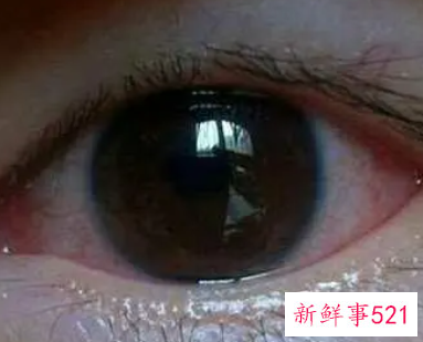 眼睛红血丝预示着哪种疾病