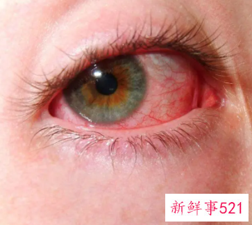 眼睛红血丝预示着哪种疾病