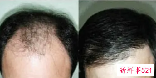 一般植发能维持多久