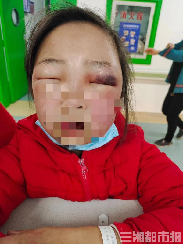 株洲9岁女孩被蜘蛛咬伤，肿得眼睛都看不见了