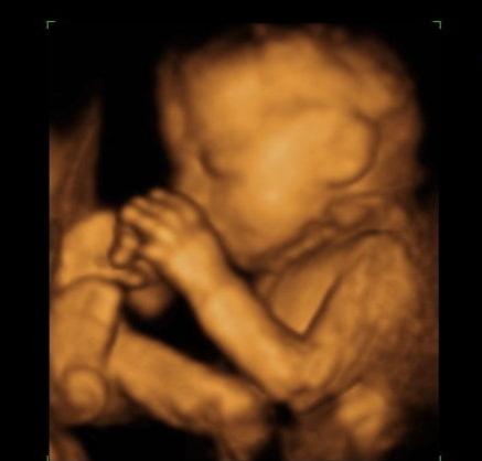 孕妈做四维彩超时，胎儿捂着脸不让看，孕妈早了解原因，少担心