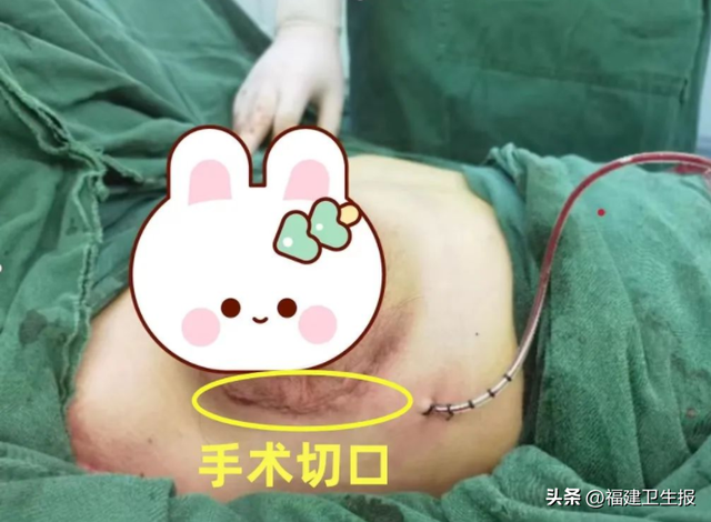 警惕！漳州16岁女孩一侧乳房像吹气球一样疯长！去医院才发现……