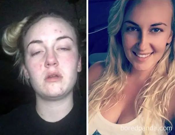 18岁的她抠出了自己的双眼珠