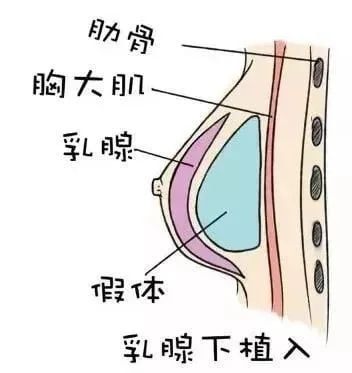 隆胸隆哪里?你真的分得清真假胸吗?