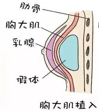 隆胸隆哪里？你真的分得清真假胸吗？