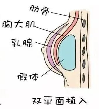 隆胸隆哪里?你真的分得清真假胸吗?