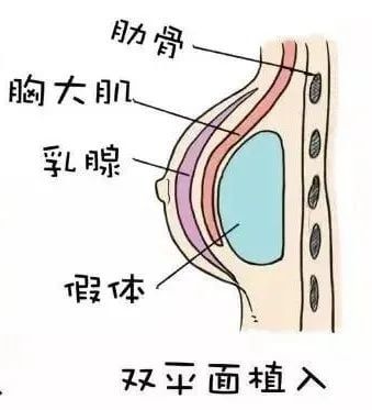 隆胸隆哪里？你真的分得清真假胸吗？